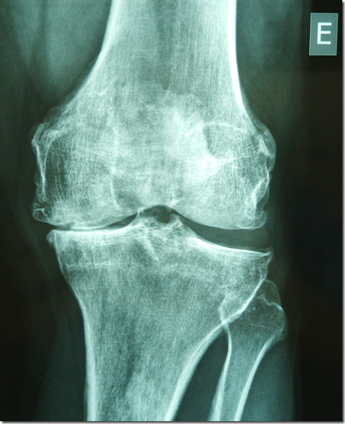 foto varo osteotomia