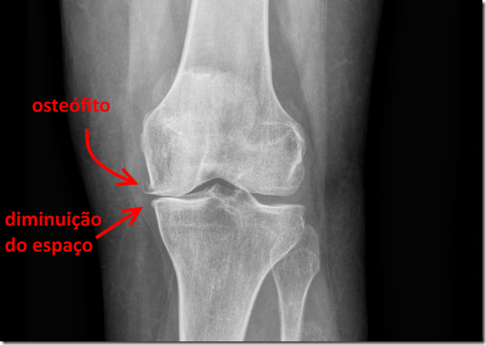 rx com sinais artrose 01